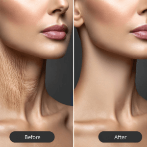 Microneedling Before & After neck