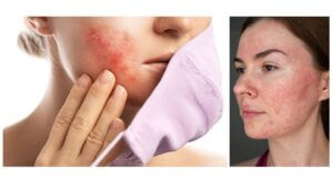 Rosacea