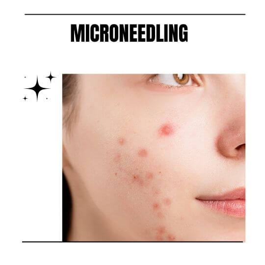 Is Microneedling Good For Acne?