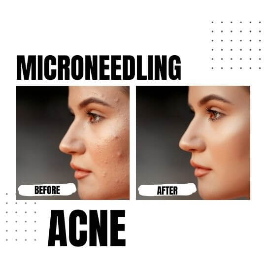 Is Microneedling Good For Acne?