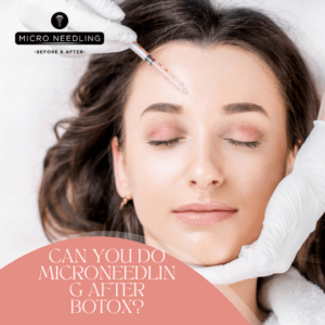 Microneedling Forehead Wrinkles
