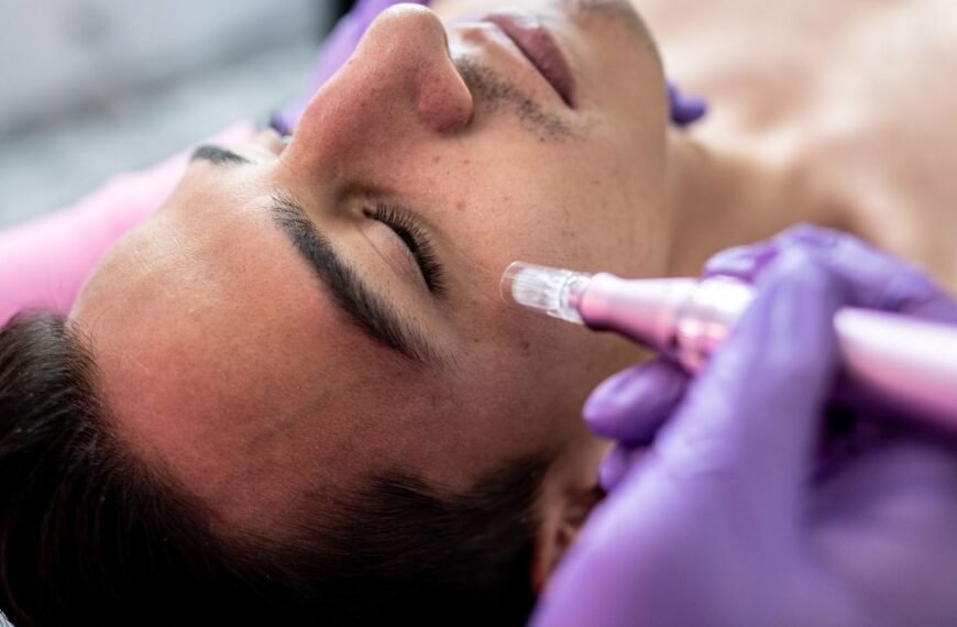 Can You Microneedle Under Eyes?