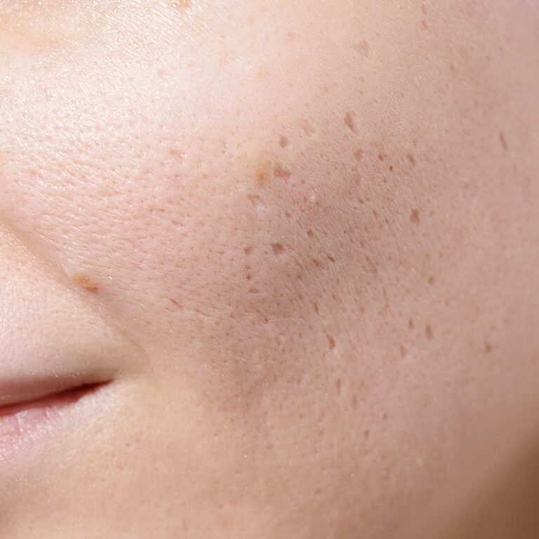 Mesotherapy for Acne Scars