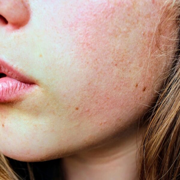 What Is Rf Microneedling