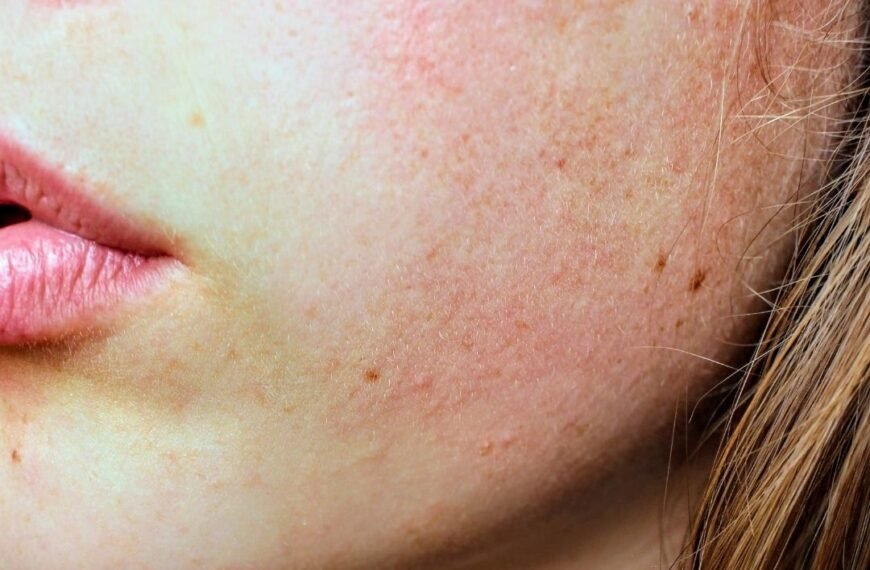 What Is Rf Microneedling