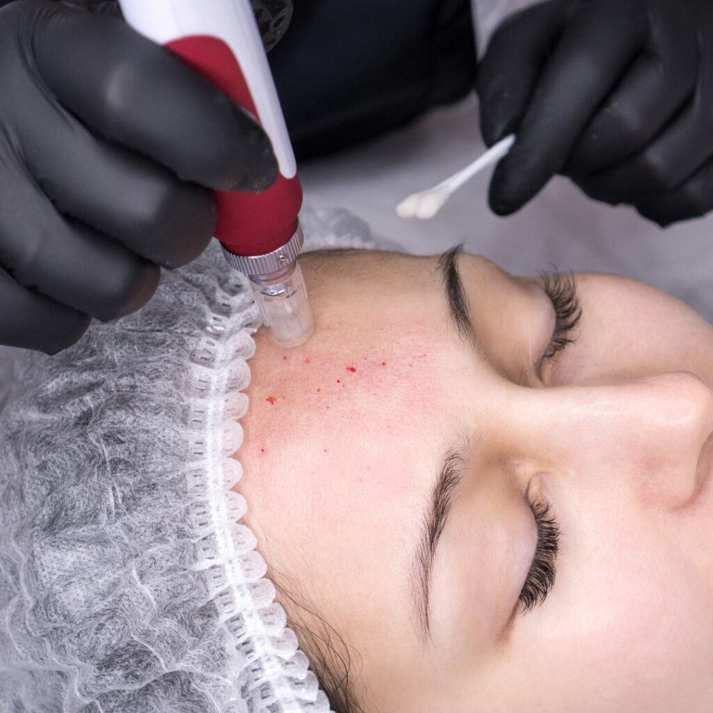 How Long To See Results From Microneedling?