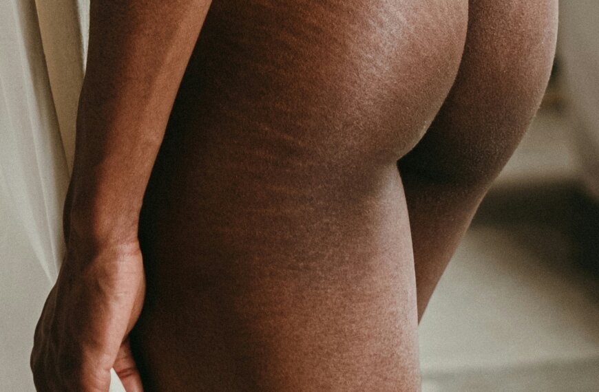 Does Microneedling Help Stretch Marks?