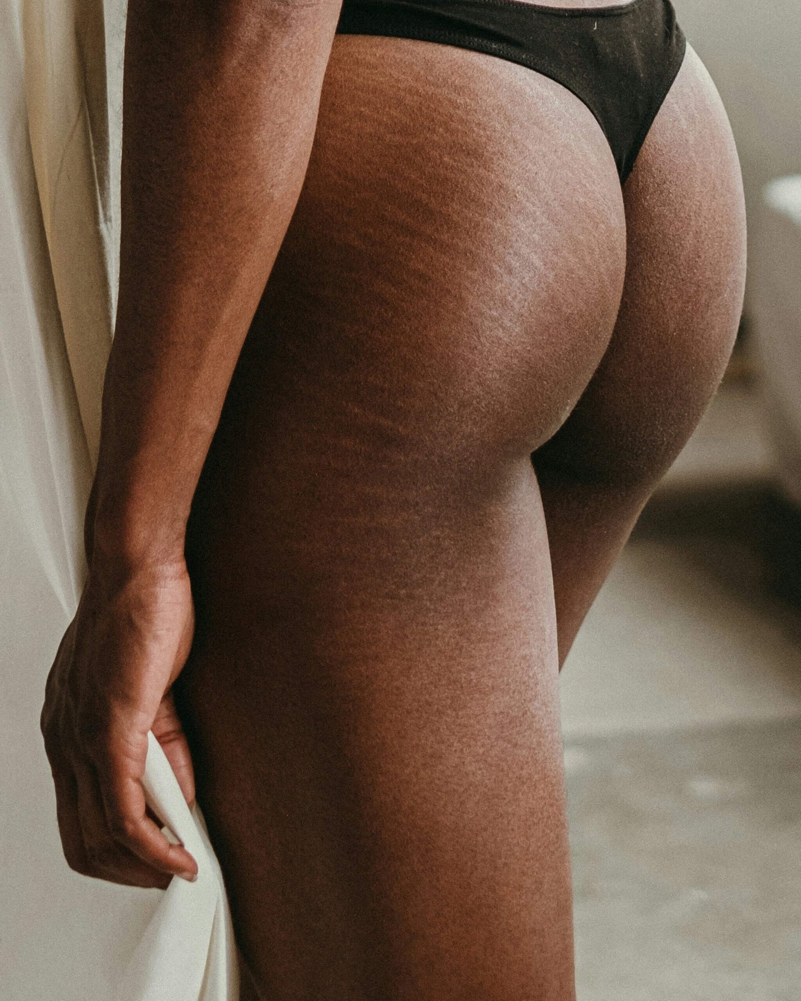 Does Microneedling Help Stretch Marks?