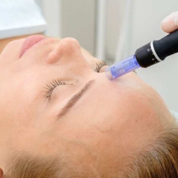Microneedling Before and After 1 Treatment