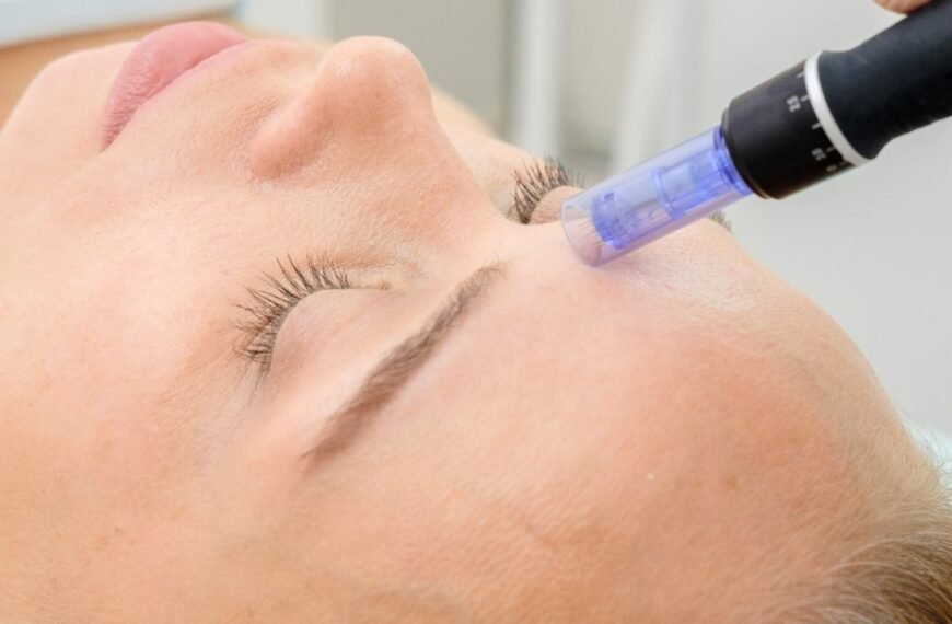 Microneedling Before and After 1 Treatment