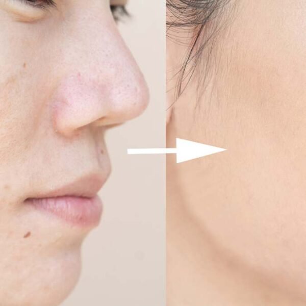 Does Microneedling Help Acne Scars?