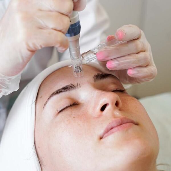 Hyaluronic Acid and Microneedling