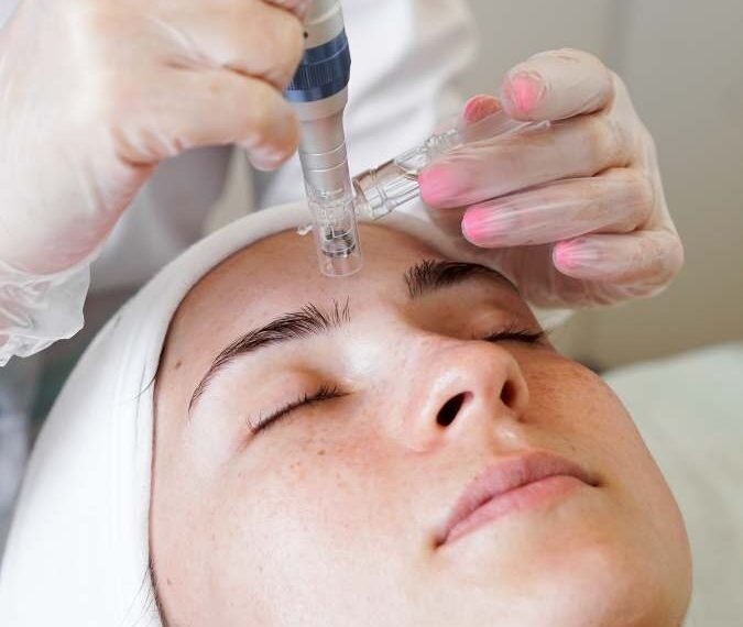 Hyaluronic Acid and Microneedling