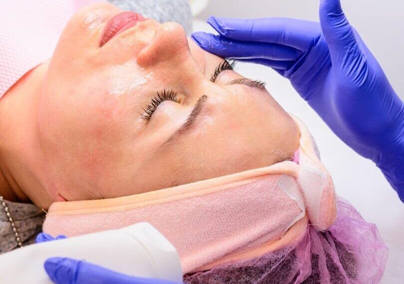 Microneedling Healing Stages