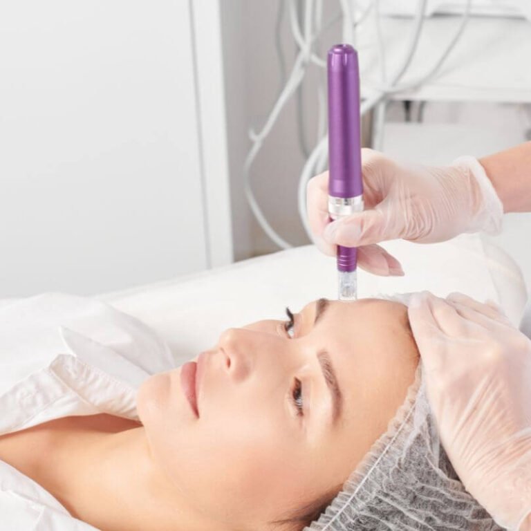 microneedling