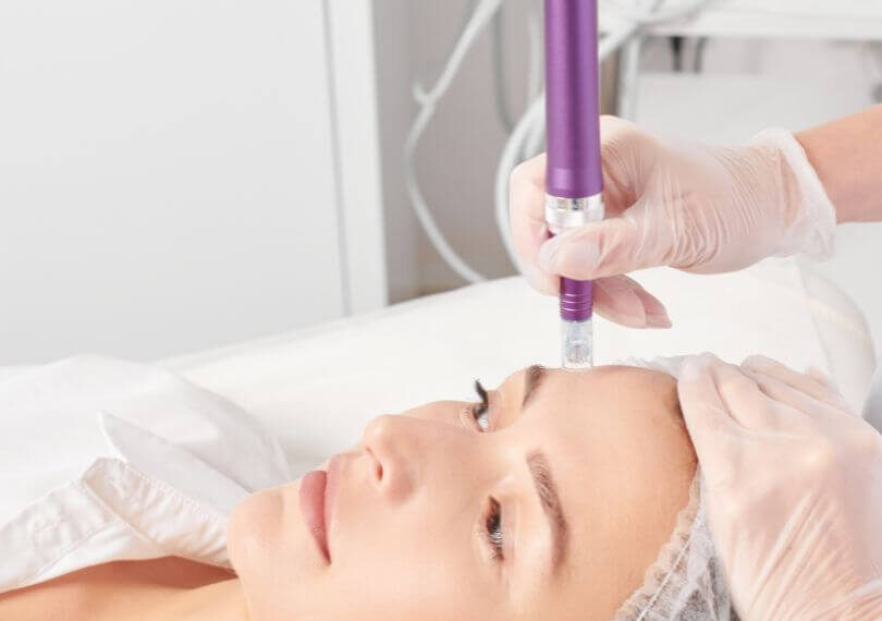 microneedling