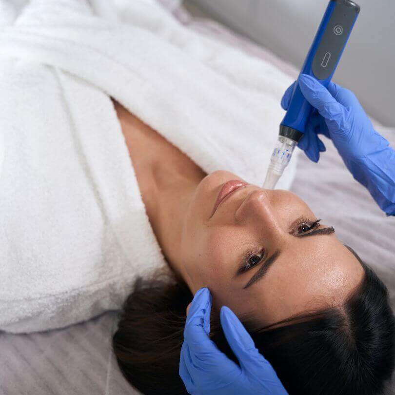 Microneedling Pigmentation