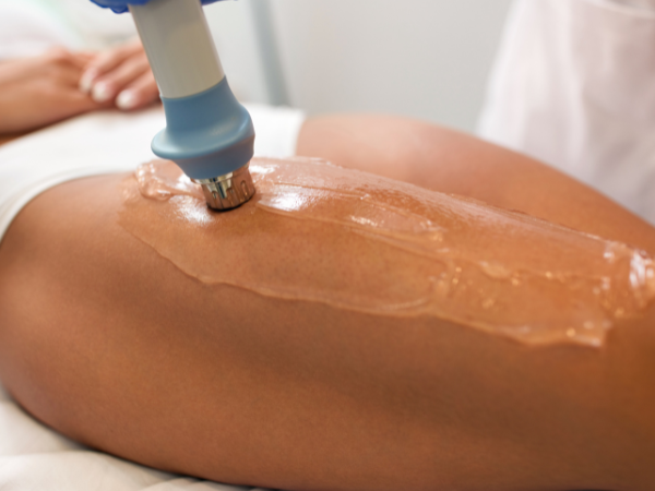 Microneedling for Cellulite