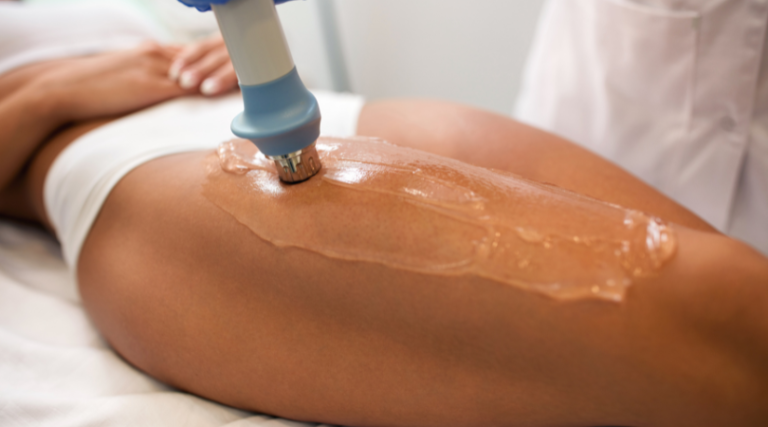 Microneedling for Cellulite