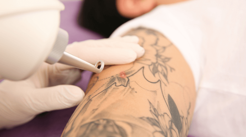 Microneedling Tattoo Removal