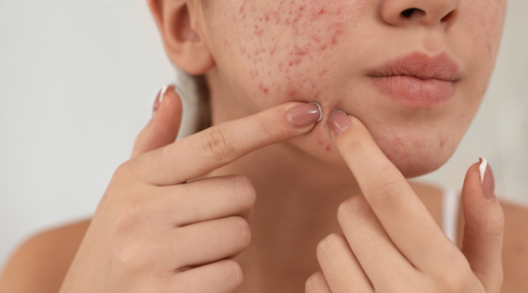 Breaking Out After Microneedling