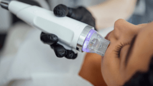 Is one session of mesotherapy worth it?