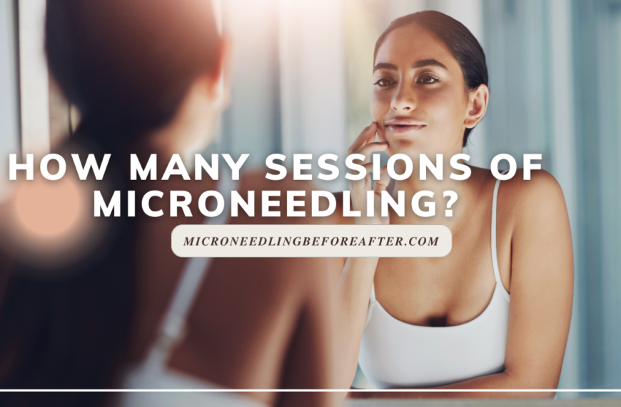 How Many Sessions Of Microneedling?