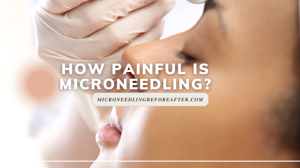 How Painful Is Microneedling?