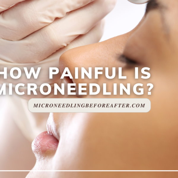 How Painful Is Microneedling?