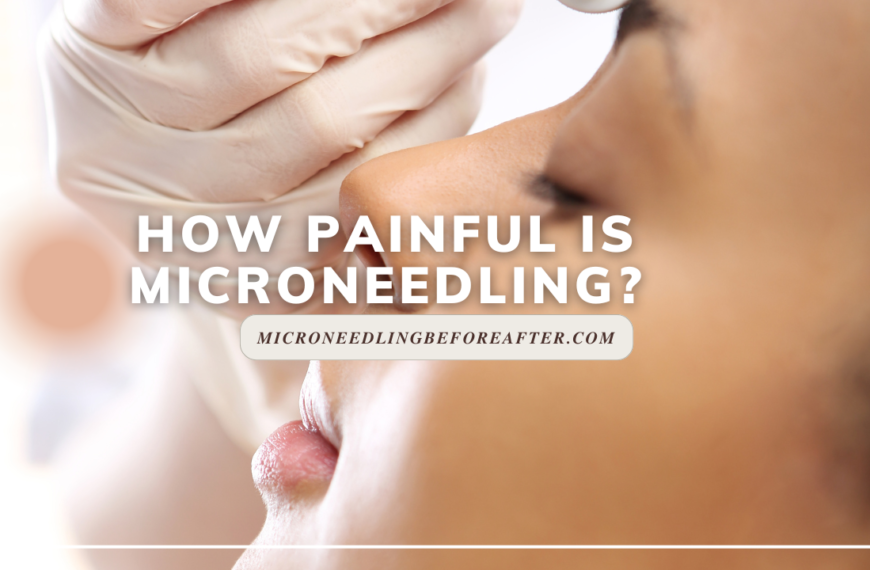 How Painful Is Microneedling?