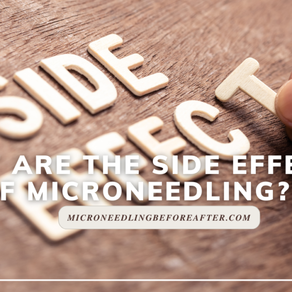 What Are The Side Effects Of Microneedling