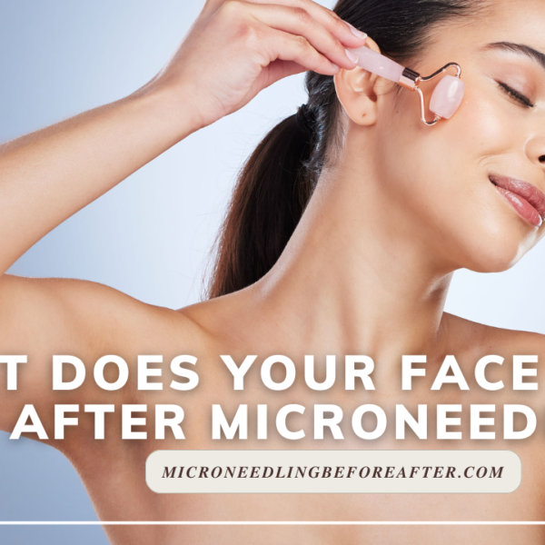 What Does Your Face Look Like After Microneedling?