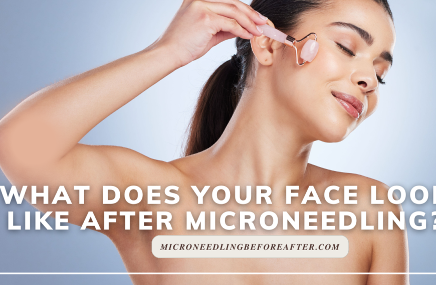 What Does Your Face Look Like After Microneedling?