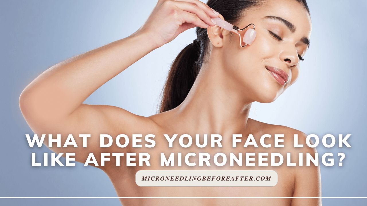 What Does Your Face Look Like After Microneedling?