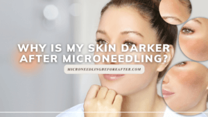 Why Is My Skin Darker After Microneedling
