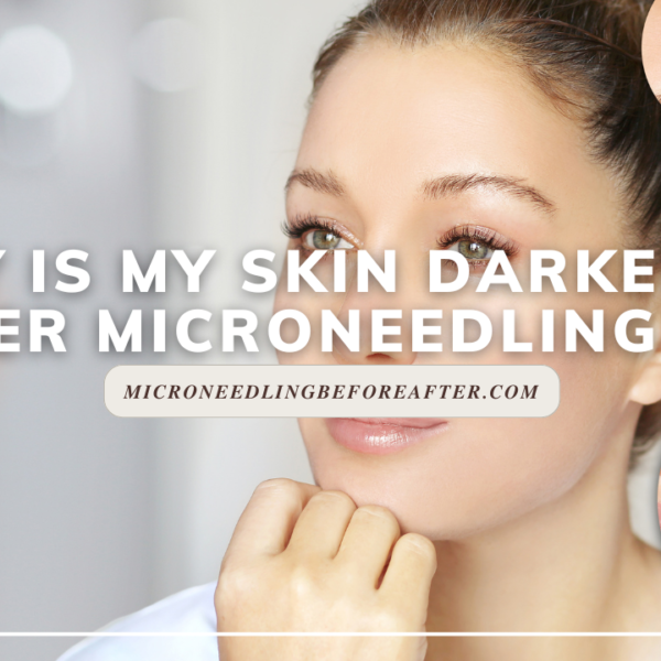 Why Is My Skin Darker After Microneedling