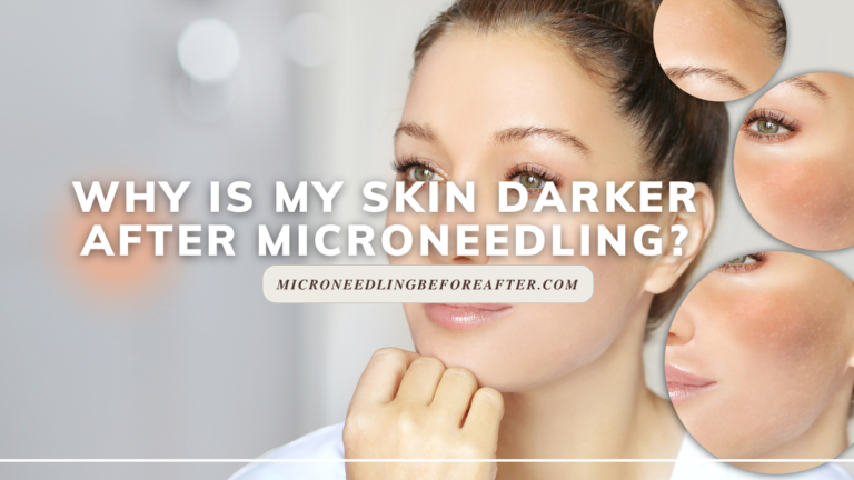 Why Is My Skin Darker After Microneedling