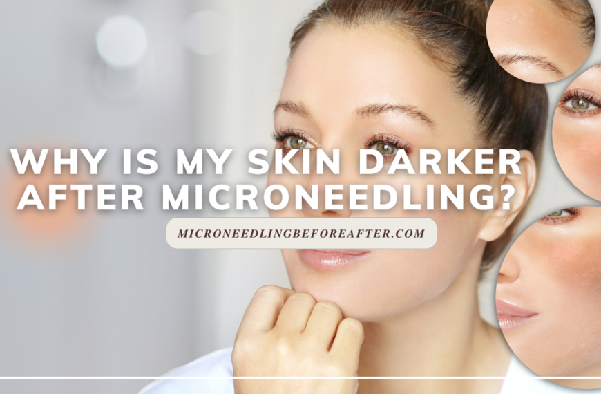 Why Is My Skin Darker After Microneedling