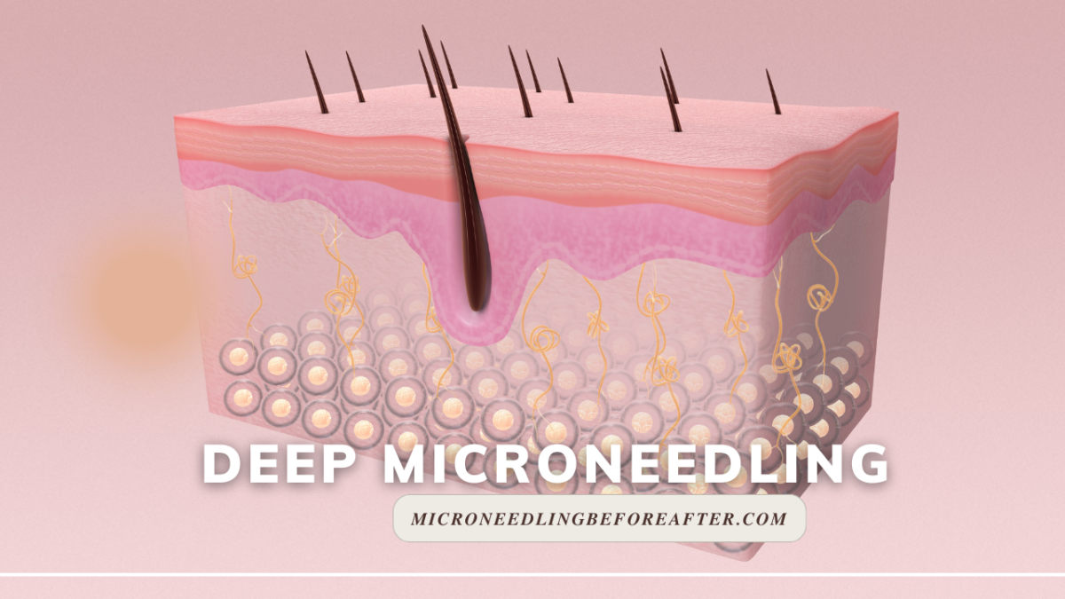 Deep Microneedling