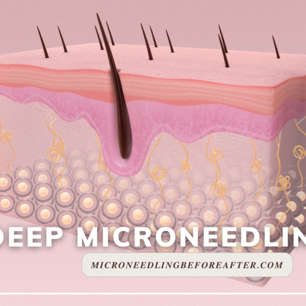 Deep Microneedling