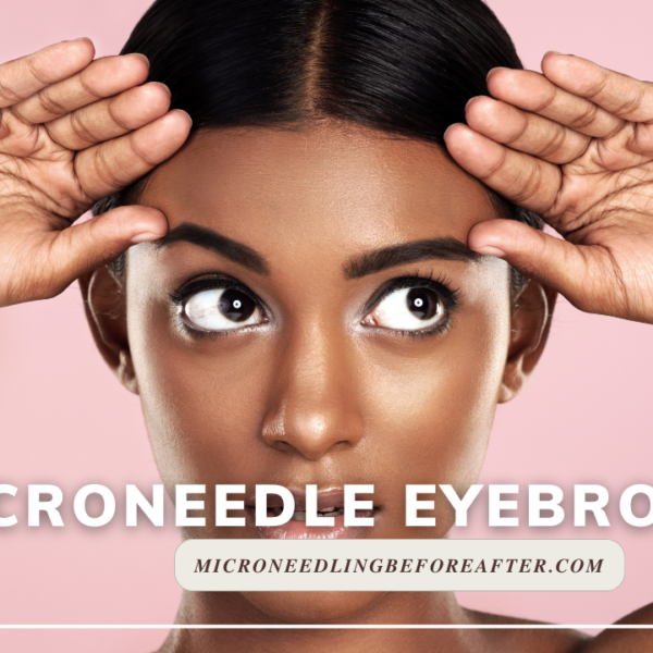 Microneedle Eyebrows