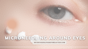 Microneedling Around Eyes