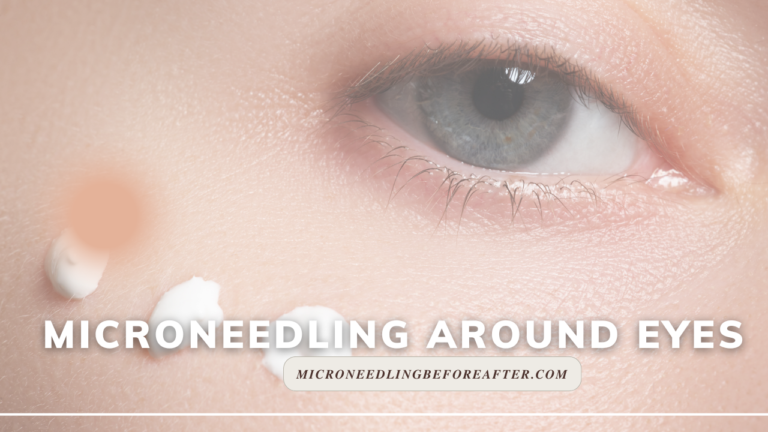 Microneedling Around Eyes