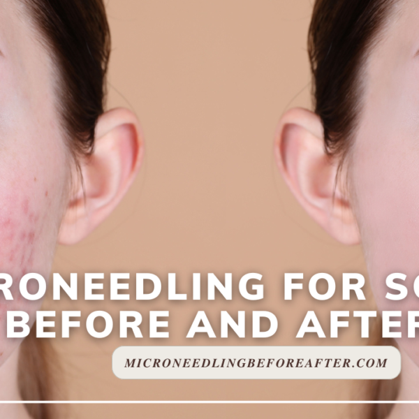 Microneedling For Scars Before And After