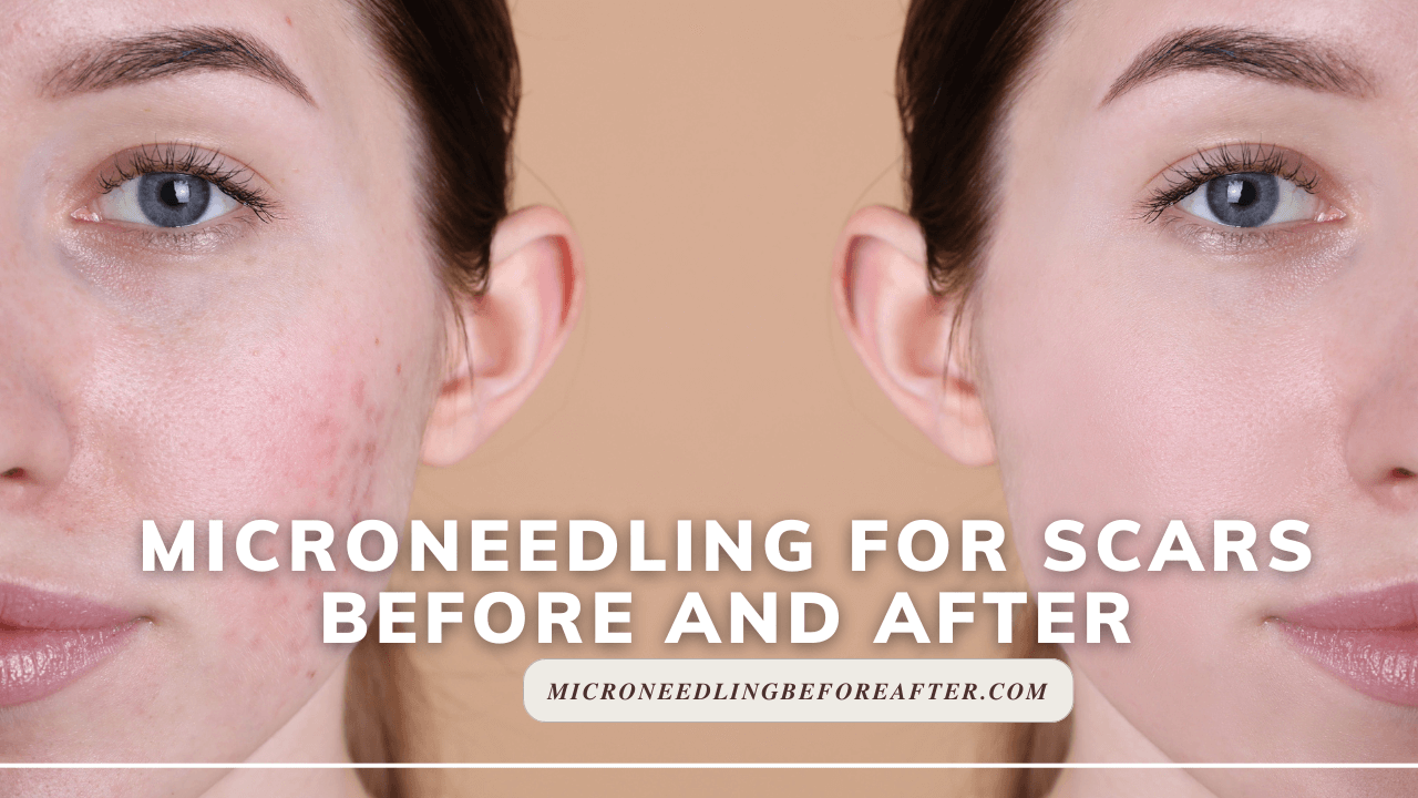 Microneedling For Scars Before And After