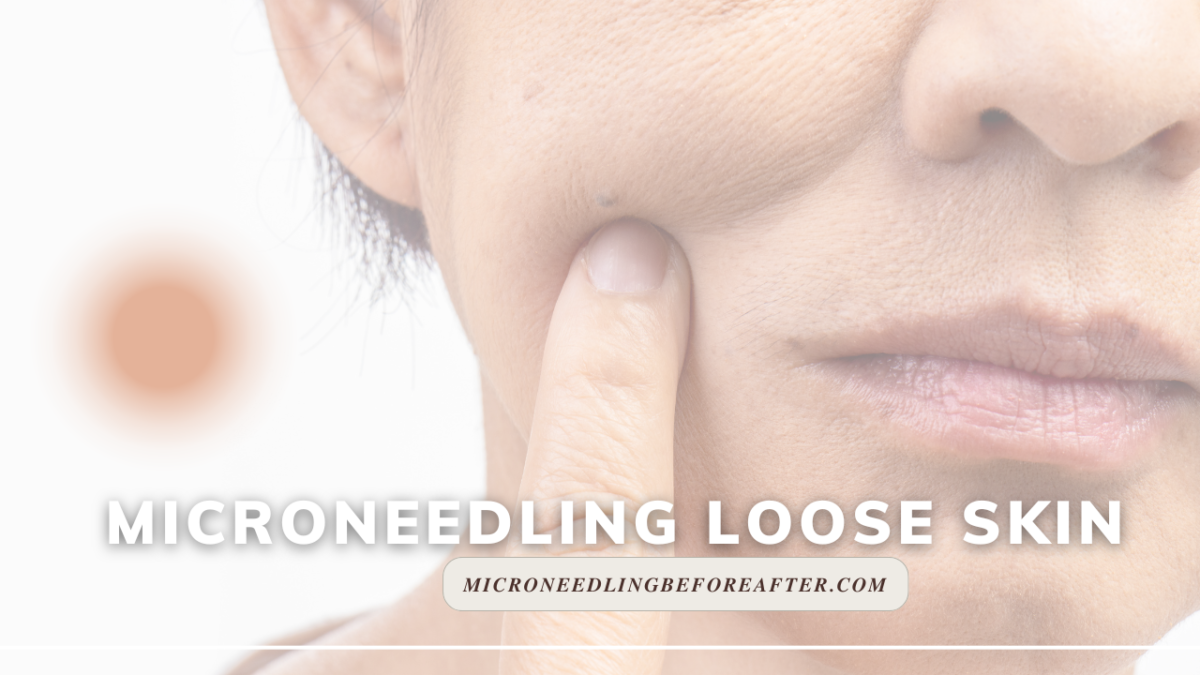 Microneedling Loose Skin