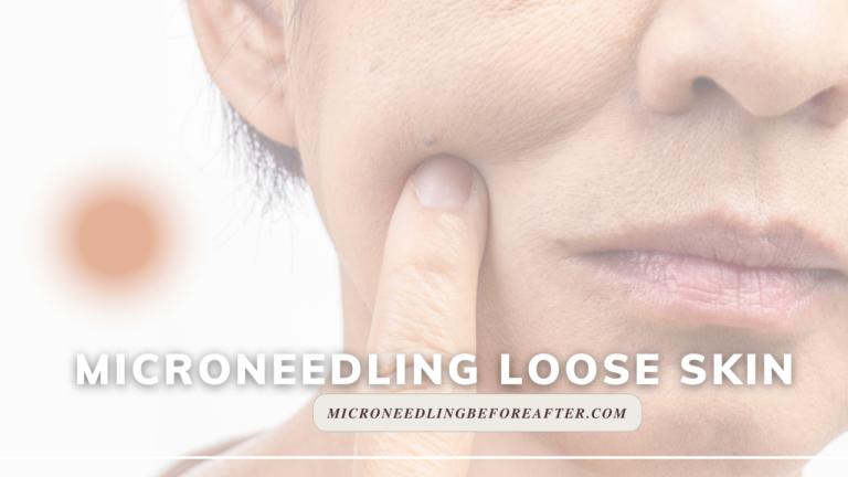 Microneedling Loose Skin