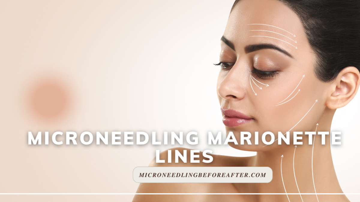 Microneedling Marionette Lines