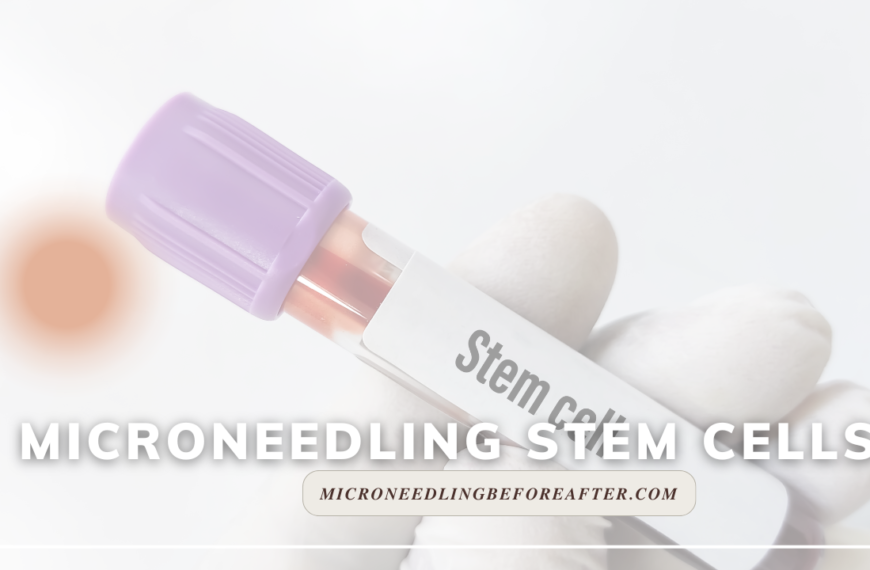 Microneedling Stem Cells