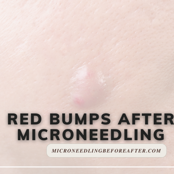 Red Bumps After Microneedling